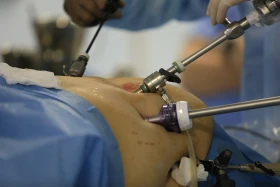 Хирургтар артық салмақпен күресуге қалай көмектеседі - фото 4